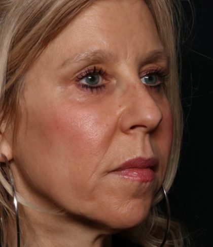 Botox and Dysport Before & After Patient #35607