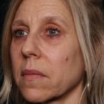 Botox and Dysport Before & After Patient #35607