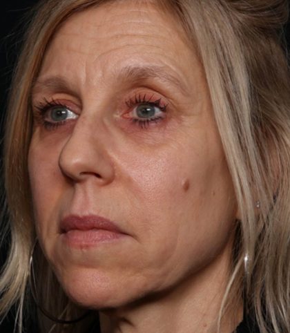 Botox and Dysport Before & After Patient #35607