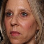 Botox and Dysport Before & After Patient #35607