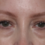Blepharoplasty Before & After Patient #35691