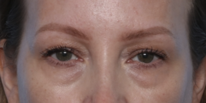 Blepharoplasty Before & After Patient #35691