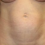 Tummy Tuck Before & After Patient #35594