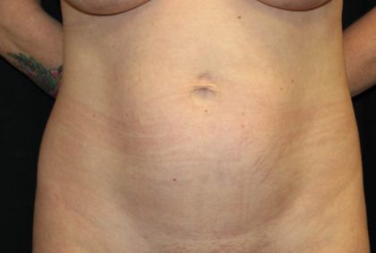 Tummy Tuck Before & After Patient #35594