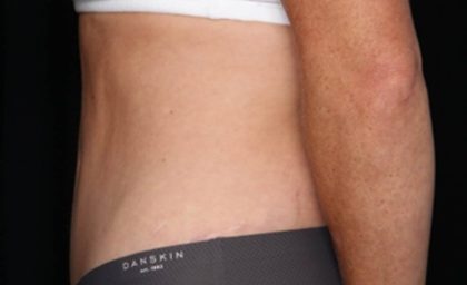 Tummy Tuck Before & After Patient #35594
