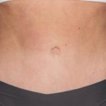 Tummy Tuck Before & After Patient #35594