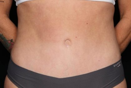 Tummy Tuck Before & After Patient #35594