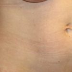 Tummy Tuck Before & After Patient #35594
