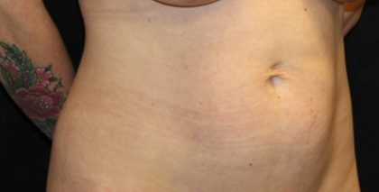 Tummy Tuck Before & After Patient #35594