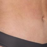 Tummy Tuck Before & After Patient #35594