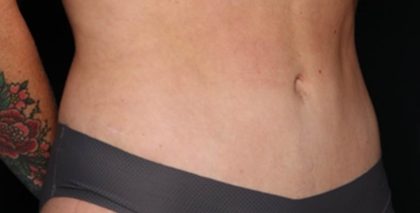 Tummy Tuck Before & After Patient #35594