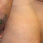 Tummy Tuck Before & After Patient #35594