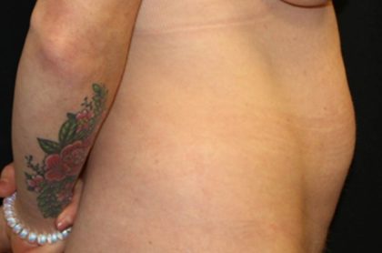 Tummy Tuck Before & After Patient #35594