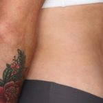 Tummy Tuck Before & After Patient #35594