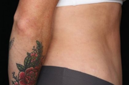 Tummy Tuck Before & After Patient #35594