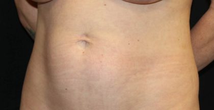 Tummy Tuck Before & After Patient #35594