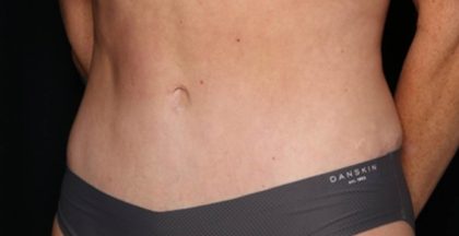 Tummy Tuck Before & After Patient #35594
