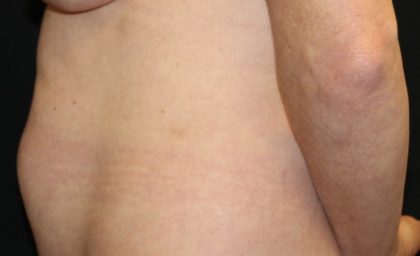 Tummy Tuck Before & After Patient #35594