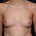 Breast Augmentation Before & After Patient #35726