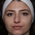 Laser Skin Resurfacing Before & After Patient #35745