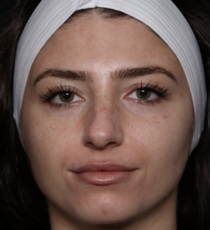 Laser Skin Resurfacing Before & After Patient #35745