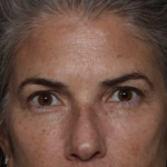 Upper Blepharoplasty Before & After Patient #35752