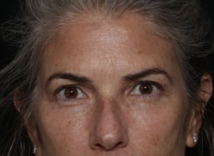 Upper Blepharoplasty Before & After Patient #35752