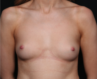 Breast Augmentation Before & After Patient #35726
