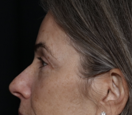 Upper Blepharoplasty Before & After Patient #35752