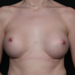 Breast Augmentation Before & After Patient #35726