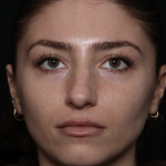 Laser Skin Resurfacing Before & After Patient #35745