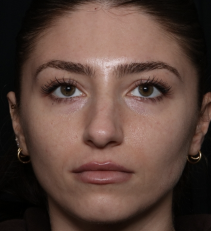 Laser Skin Resurfacing Before & After Patient #35745