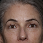 Upper Blepharoplasty Before & After Patient #35752
