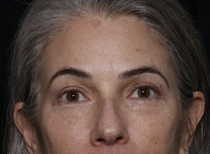 Upper Blepharoplasty Before & After Patient #35752