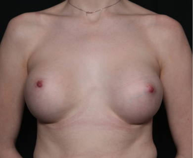 Breast Augmentation Before & After Patient #35726