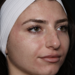 Laser Skin Resurfacing Before & After Patient #35745