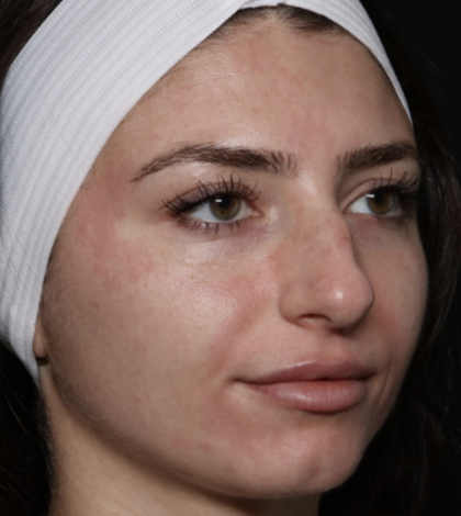 Laser Skin Resurfacing Before & After Patient #35745