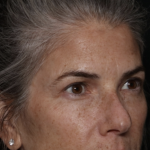 Upper Blepharoplasty Before & After Patient #35752