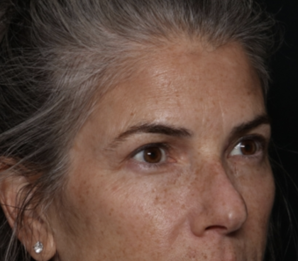 Upper Blepharoplasty Before & After Patient #35752