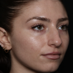 Laser Skin Resurfacing Before & After Patient #35745