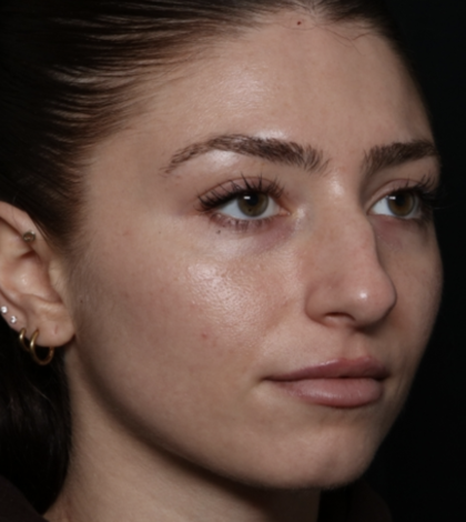 Laser Skin Resurfacing Before & After Patient #35745