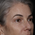 Upper Blepharoplasty Before & After Patient #35752