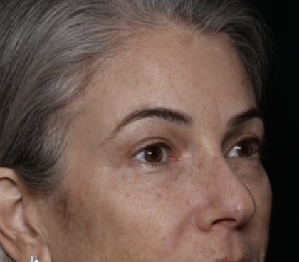 Upper Blepharoplasty Before & After Patient #35752