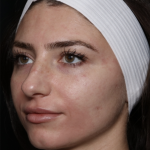 Laser Skin Resurfacing Before & After Patient #35745