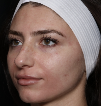 Laser Skin Resurfacing Before & After Patient #35745