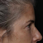Upper Blepharoplasty Before & After Patient #35752