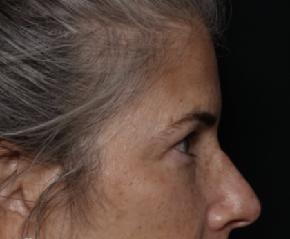 Upper Blepharoplasty Before & After Patient #35752
