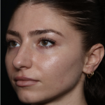 Laser Skin Resurfacing Before & After Patient #35745