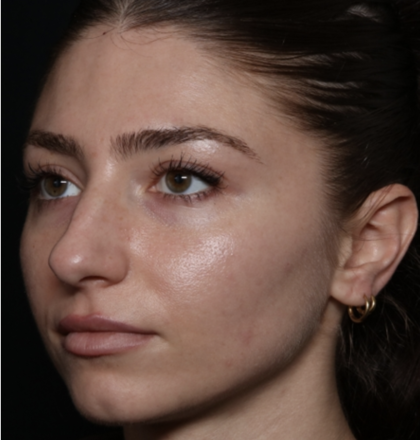 Laser Skin Resurfacing Before & After Patient #35745