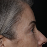 Upper Blepharoplasty Before & After Patient #35752